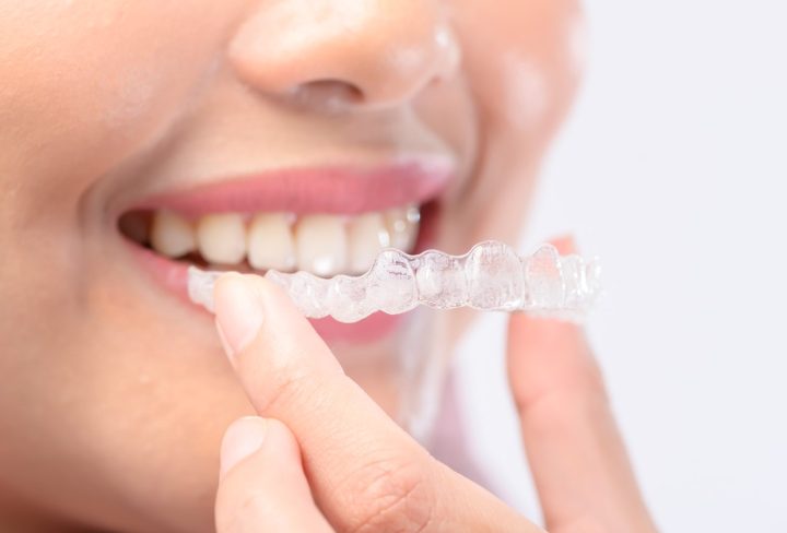 Clear Aligners